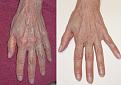 اضغط على الصورة لعرض أكبر. 

الإسم:	vein-removal-hand[1].jpg 
مشاهدات:	196 
الحجم:	83.1 كيلوبايت 
الهوية:	3287009